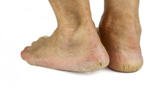 Oakville Foot Clinic, Milton, Physio, Massage, RMT, BurlON, warts, corns, callouses, foot pain