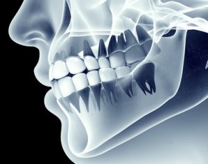 Xray of Jaw showing Oakville Physio for TMJ 