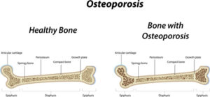 Bones showing osteoporosis showing oakville Physio and massage clinic