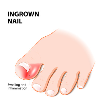 Painful Ingrown Toenail? - Palermo Physiotherapy & Wellness Centre Oakville