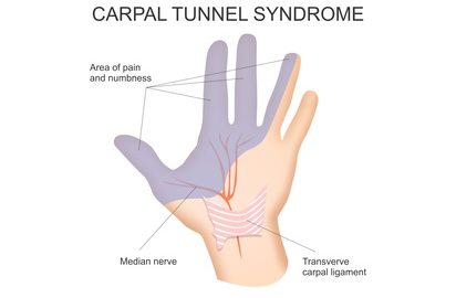 Carpal Tunnel Syndrome - Palermo Physiotherapy & Wellness Centre Oakville